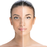 Acne treatment in Pune